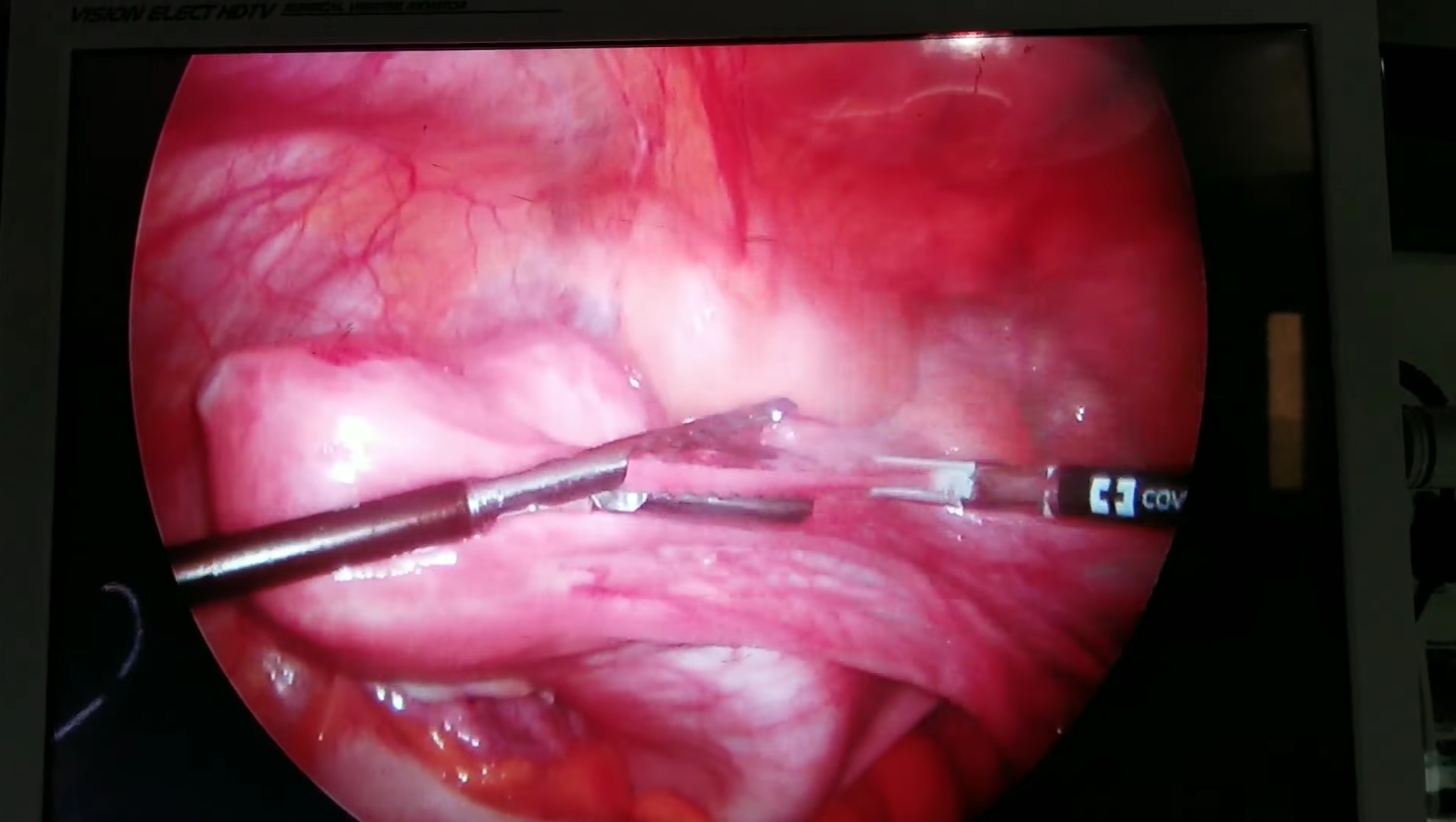 Tüp Ligasyonu (Tüplerin bağlanması)