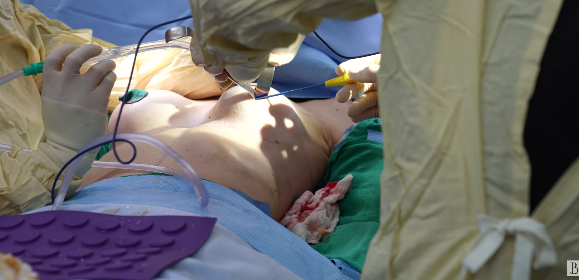 Göğüs Dikleştirme Ameliyatı