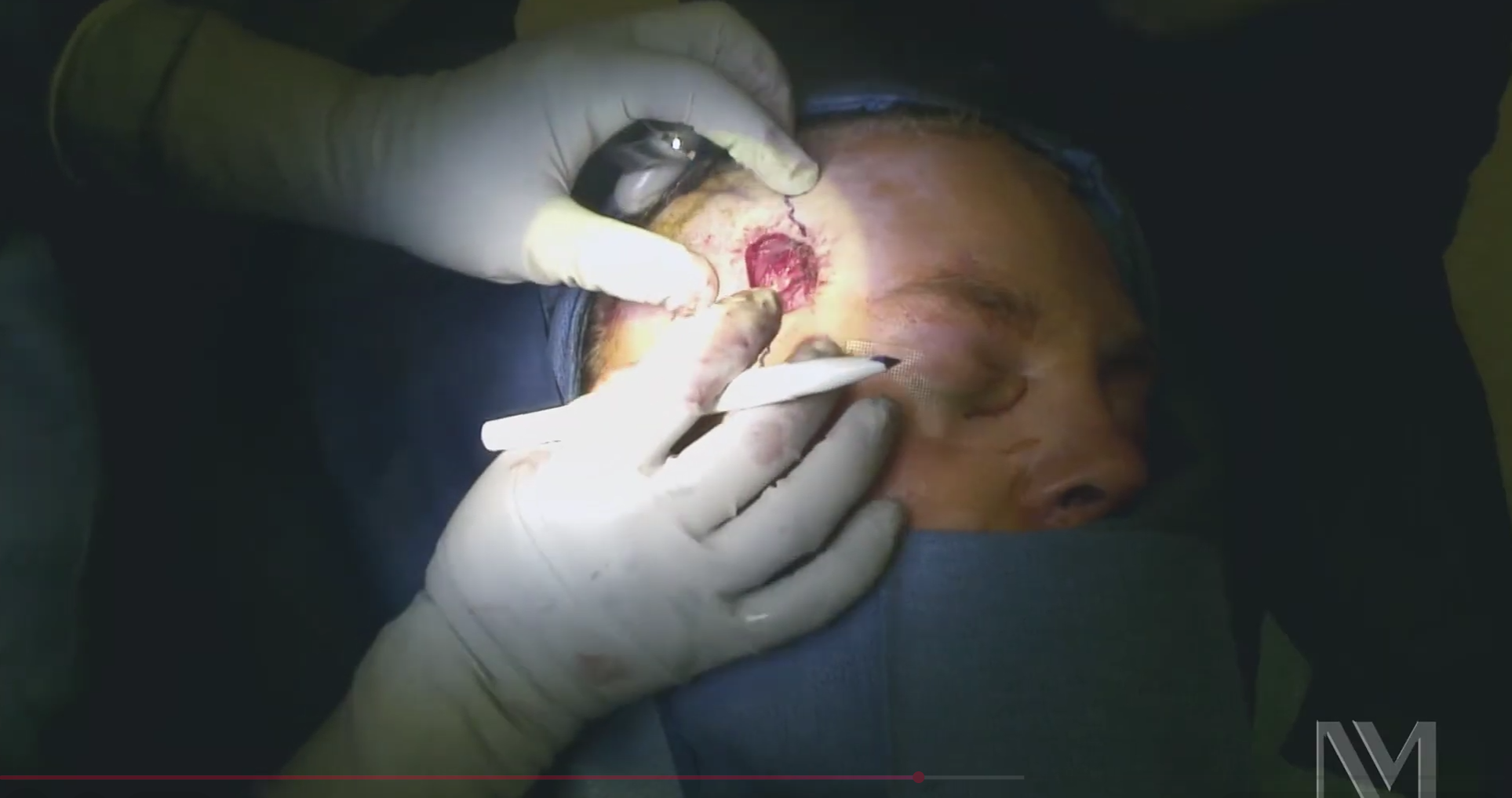 cilt-grefti-uygulamasi