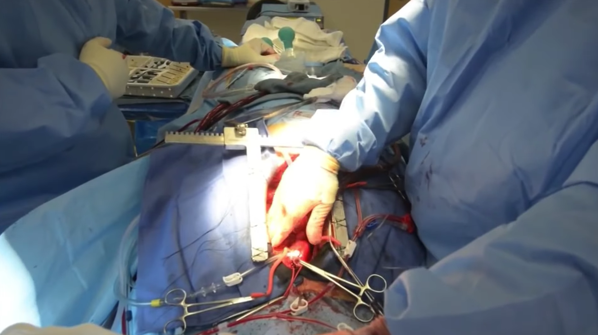 Koroner Arter Bypass Grefti (CABG)