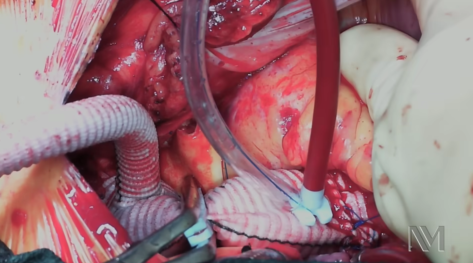 Aort Anevrizması Cerrahisi