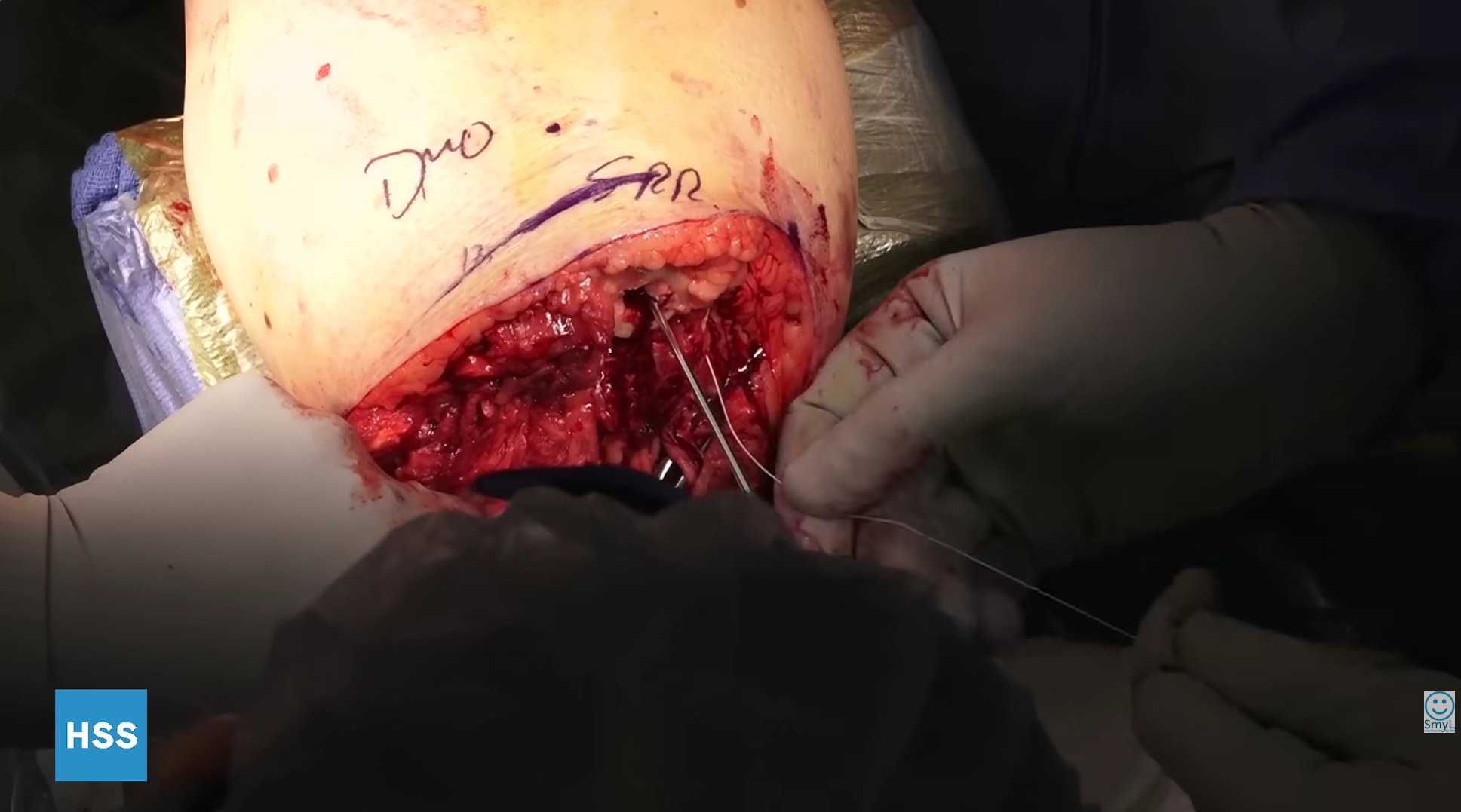 Anterior Çapraz Bağ (ACL) Rekonstrüksiyonu