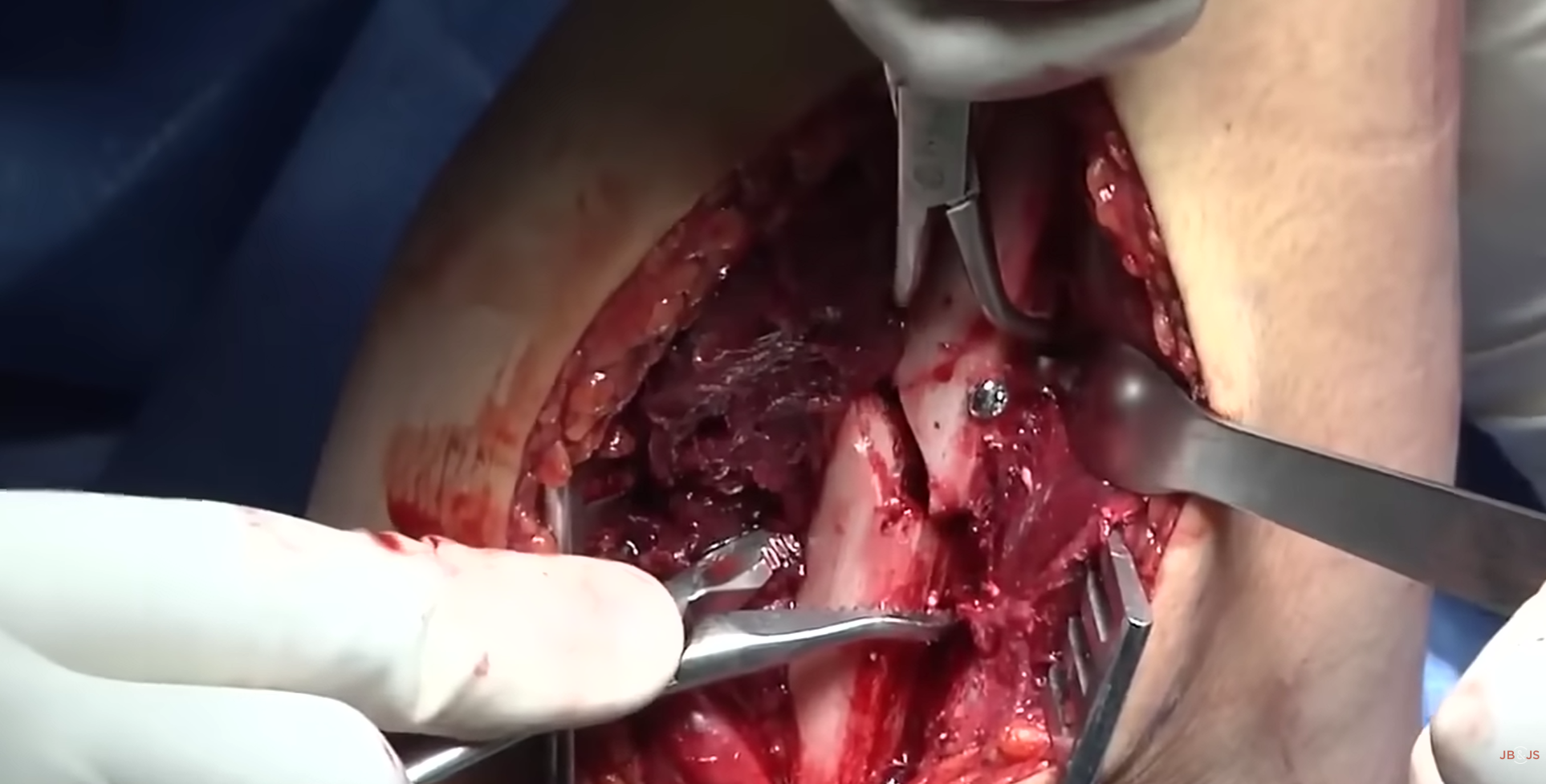 Total Diz Protezi (Diz Artroplastisi)