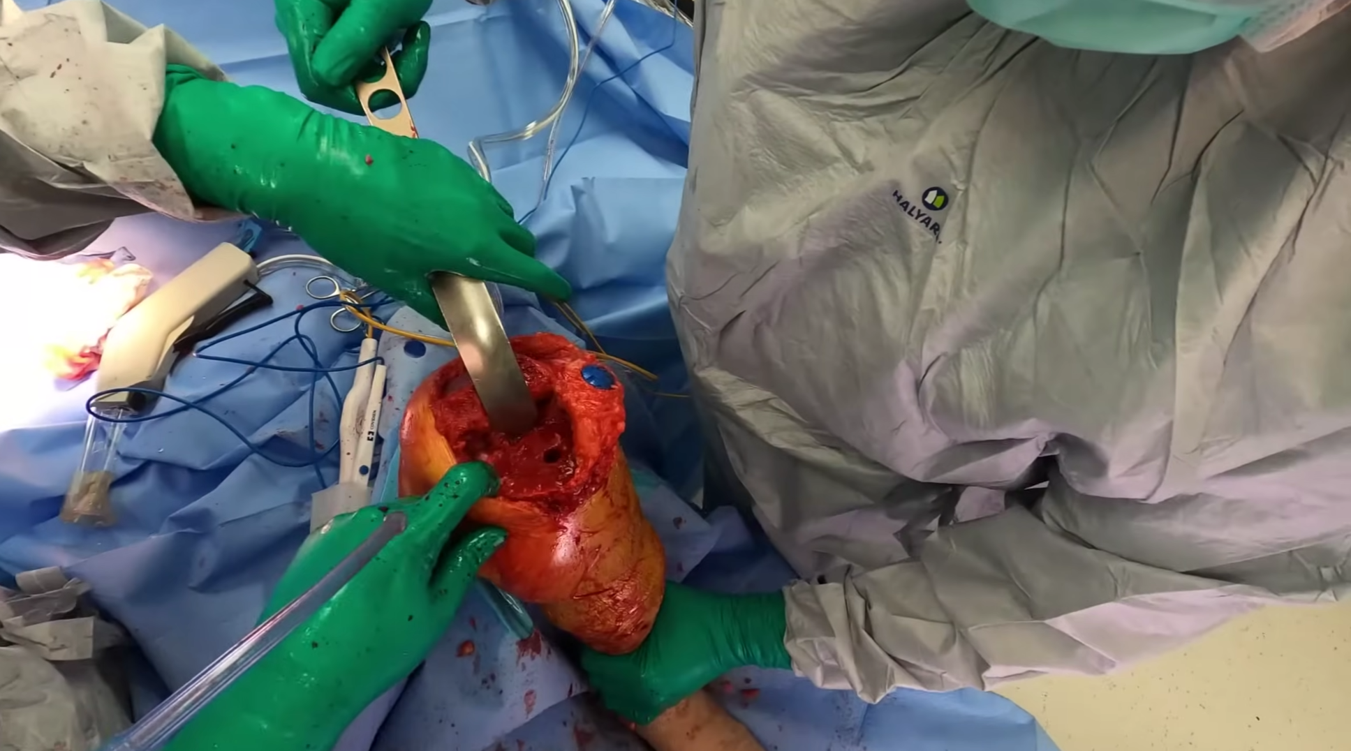 Kalça Protezi (Total Kalça Artroplastisi)