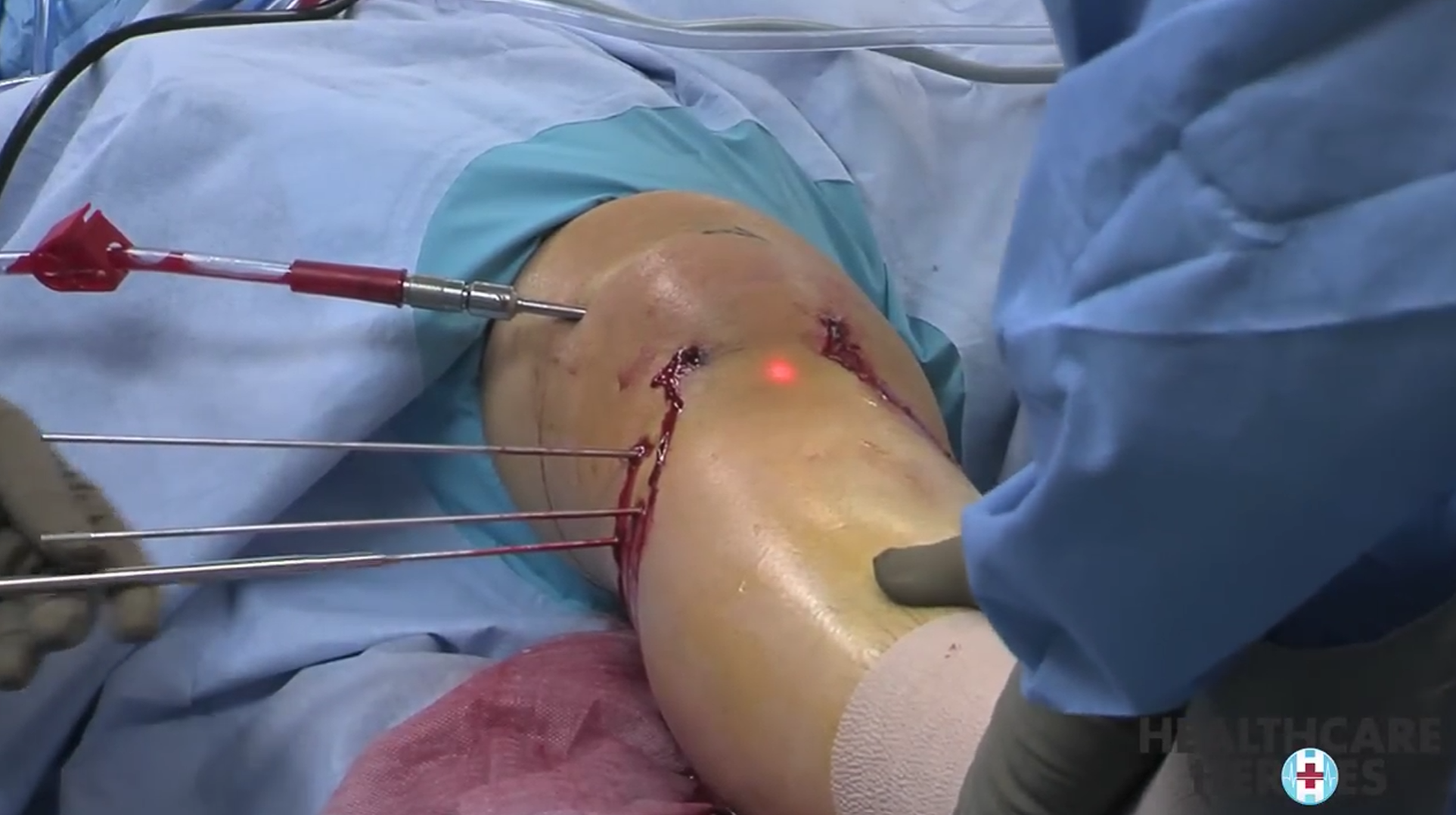 Rotator Manşet Onarımı (Omuz)