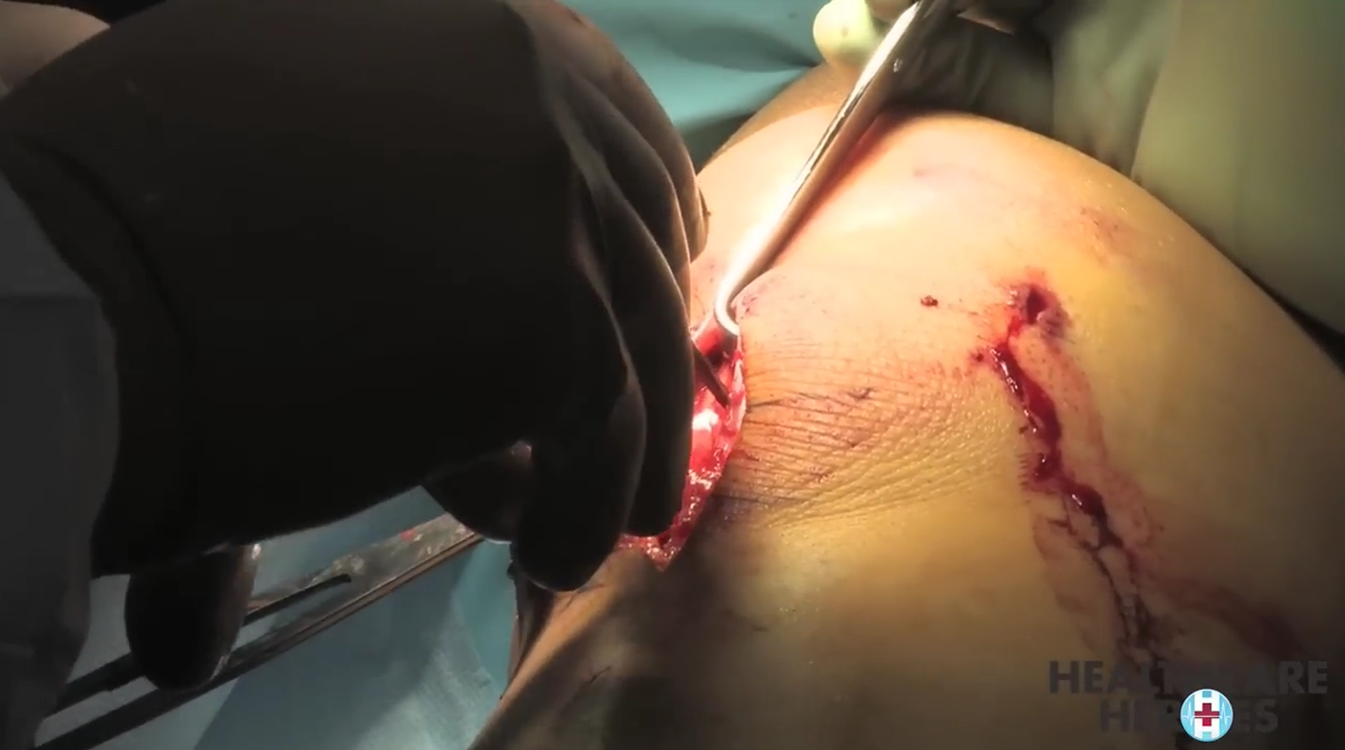 Skolyoz Cerrahisi (Spinal Füzyon)