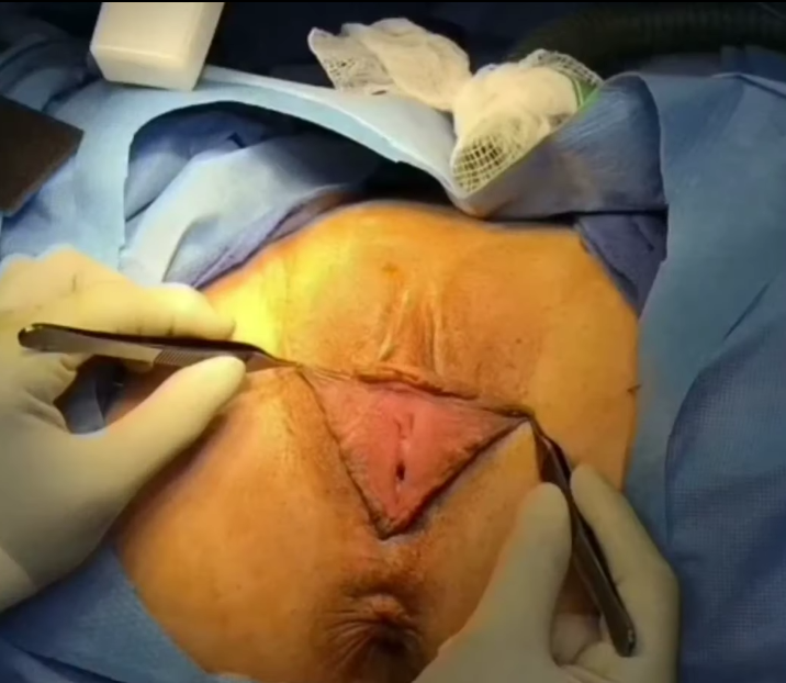 Histerektomi Rahmin alınması