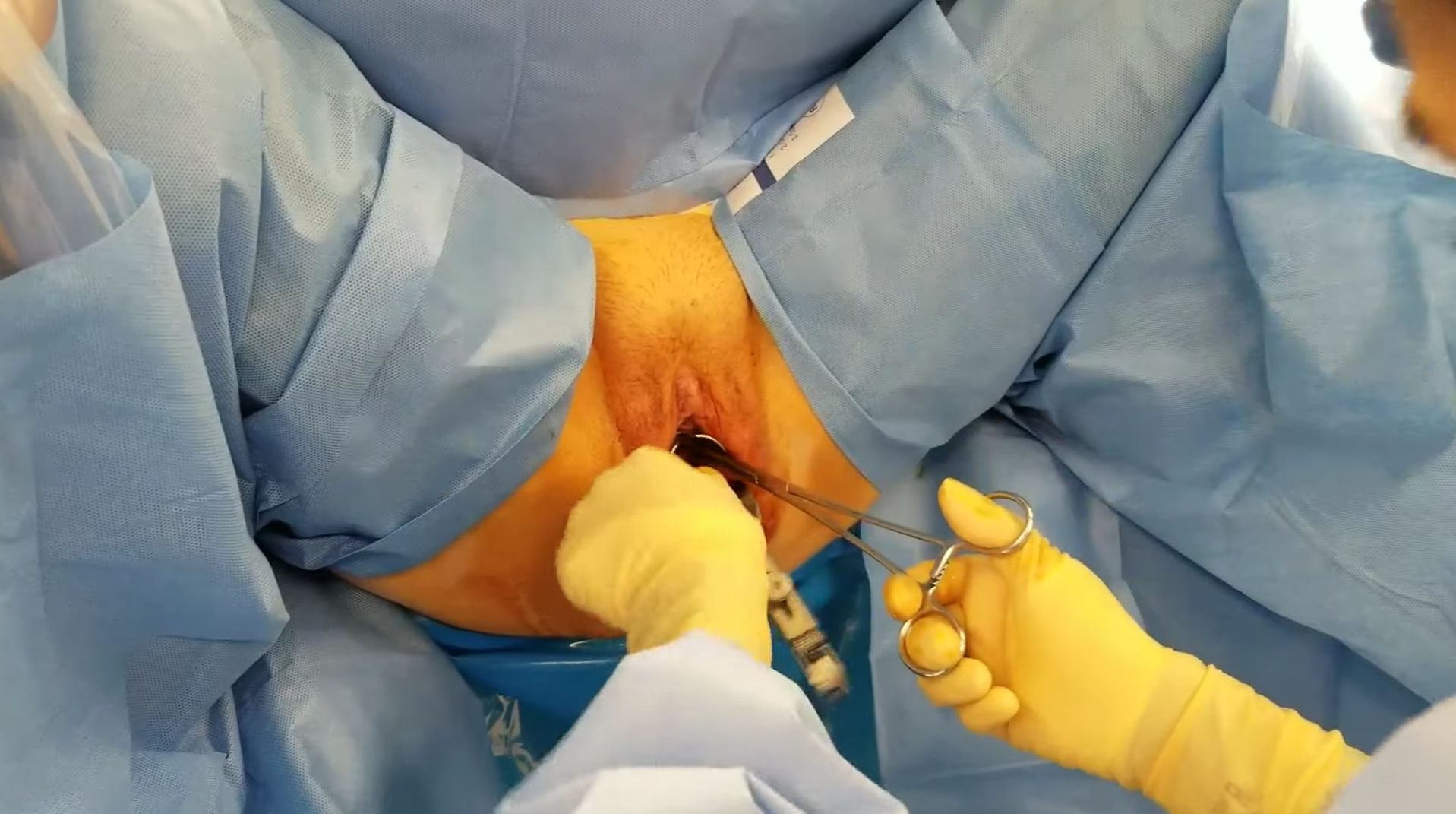 Laparoskopik Endometriozis Cerrahisi