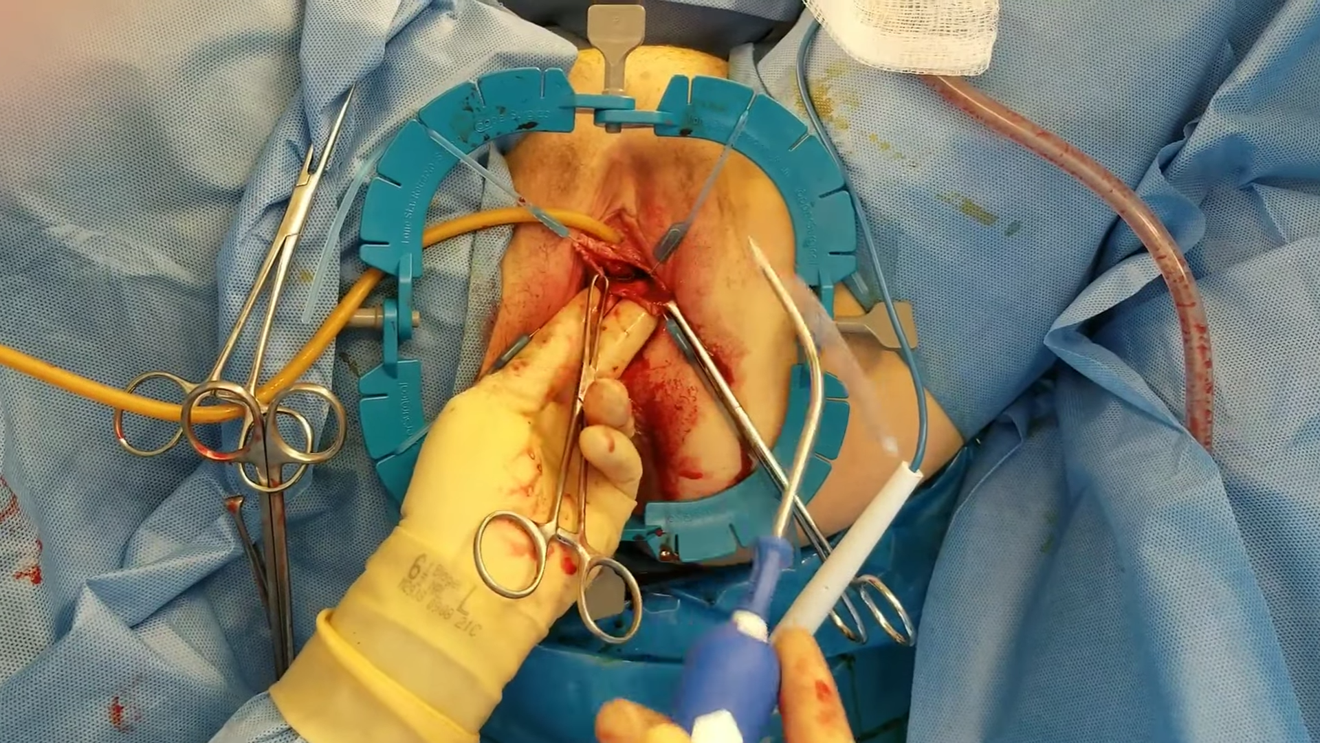 Myomektomi (Miyomların çıkarılması)