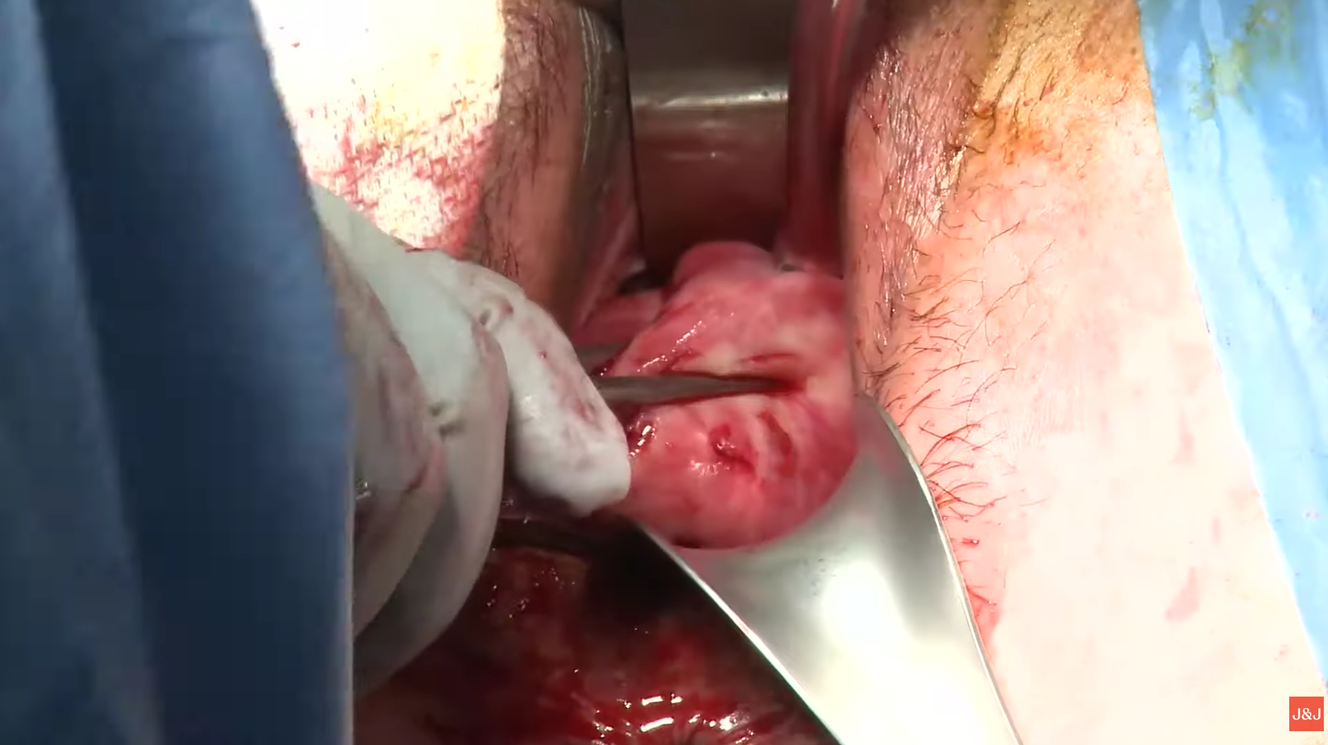 Histerektomi (Rahmin alınması)